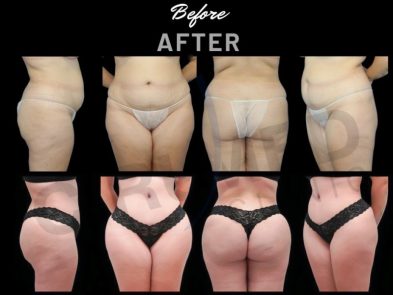 Resultados de una liposucción y aumento de glúteos realizados en Marbella - España.