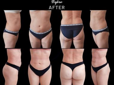 "Abdomen and flank liposuction results at Cirumed Clinic, Marbella, Spain."