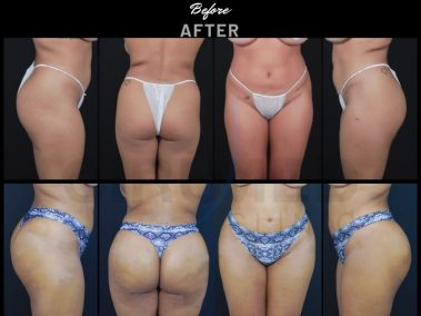 Result of a buttock augmentation performed in Marbella - Spain.