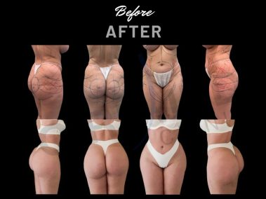 Result of a buttock augmentation performed - bbl before and after