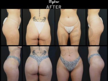 Result of a buttock augmentation performed - bbl before and after