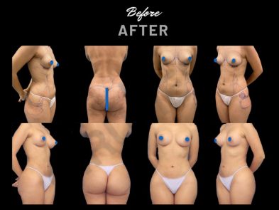Breast augmentation and liposuction results in Marbella, Spain.