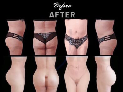 Results of liposuction of the abdomen and buttocks in Marbella, Spain.
