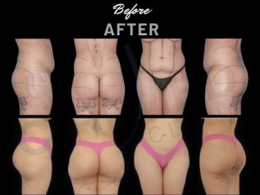 "Results of a buttock augmentation in Marbella, Spain."