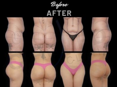 "Results of a buttock augmentation in Marbella, Spain."