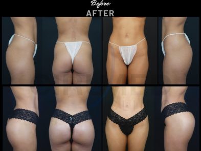 "Buttock augmentation results in Marbella, Spain."