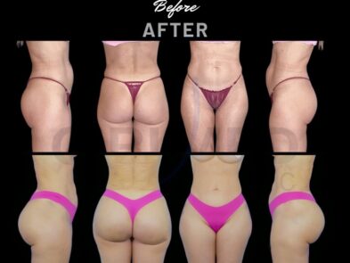 Before and after a buttock augmentation performed in Marbella, Spain.