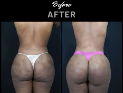 "Results of buttock augmentation performed in Marbella, Spain."