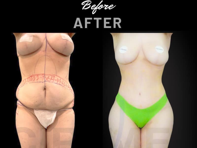 Resultado con cambio extremo de ribmold antes y después hecho por Dr. Aslani en Marbella - España