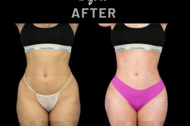 Resultado de Ribmold de mujer antes y después realizado por Dr. Aslani en Marbella - España