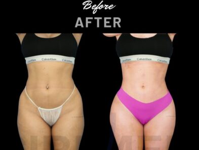 Before and after results of a woman's Ribmold performed by Dr. Aslani in Marbella, Spain.