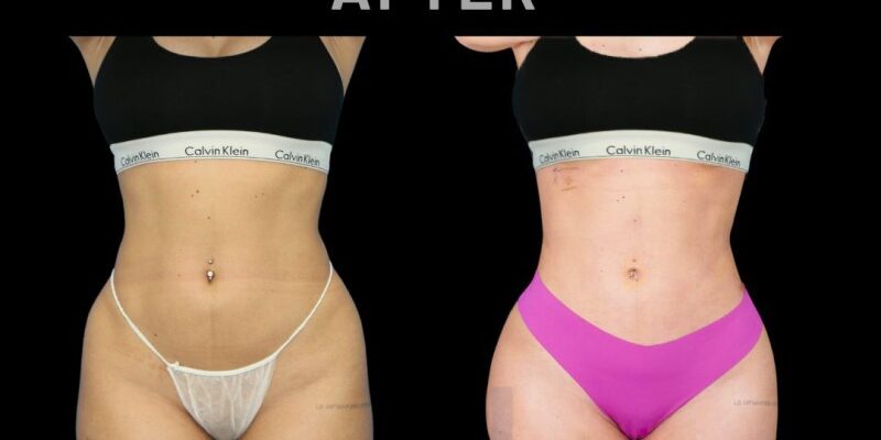 RibMold4 Resultado de Ribmold de mujer antes y después realizado por Dr. Aslani en Marbella - España