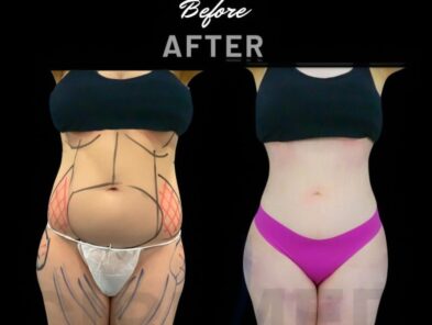 "Results of abdominal liposuction in Marbella, Spain."