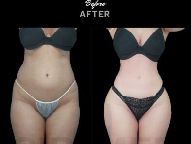 Ribmold in a woman before and after - results from Dr. Aslani in Marbella, Spain