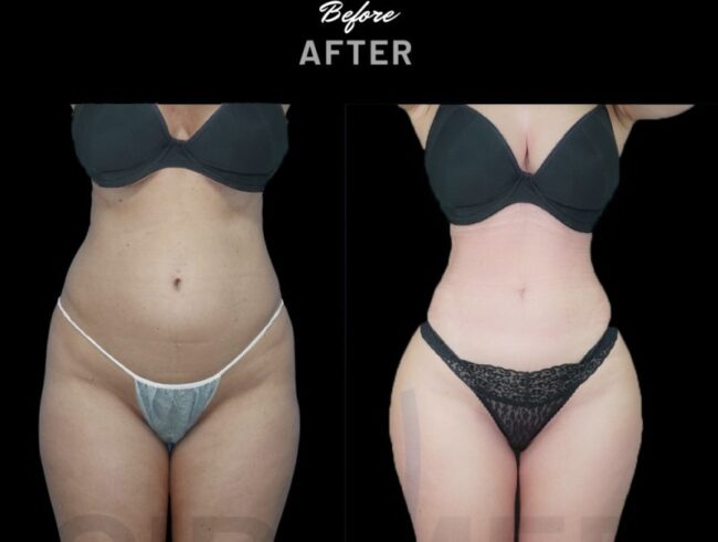 Ribmold en mujer antes y después - resultado del Dr. Aslani en Marbella - España