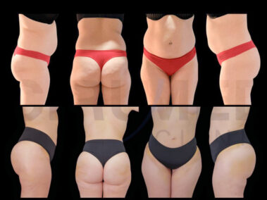 Results of a buttock augmentation performed in Marbella, Spain.