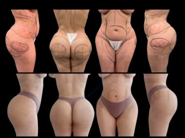 Result of a buttock augmentation performed in Marbella - Spain.