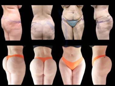Result of buttock augmentation performed in Marbella - Spain.