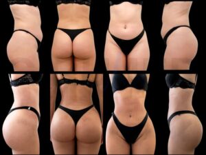 Resultados de un aumento de glúteos y liposucción antes y después en Cirumed Clinic, Marbella - España.