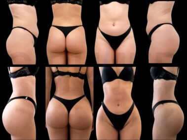 Before and after results of buttock augmentation and liposuction at Cirumed Clinic, Marbella, Spain.
