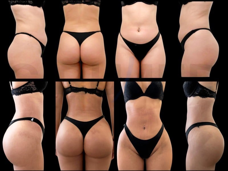 Resultados de un aumento de glúteos y liposucción antes y después en Cirumed Clinic, Marbella - España.
