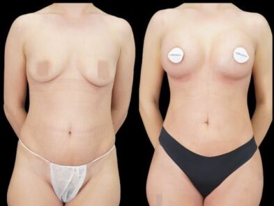 Breast augmentation results performed in Marbella, Spain.