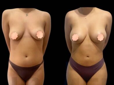 Breast augmentation results in Marbella - Spain.