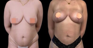 Breast augmentation results performed in Marbella, Spain.