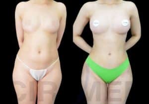 Bikini make over, antes y después realizado en Marbella - España.