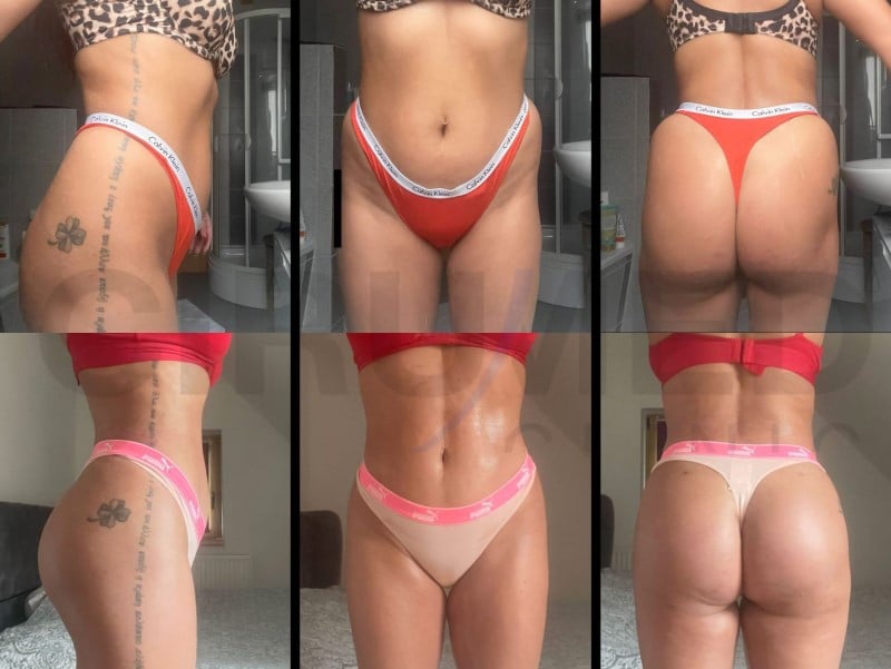 Resultado mujer con glúteo cuadrado de un aumento de glúteos antes y despues en Marbella - España