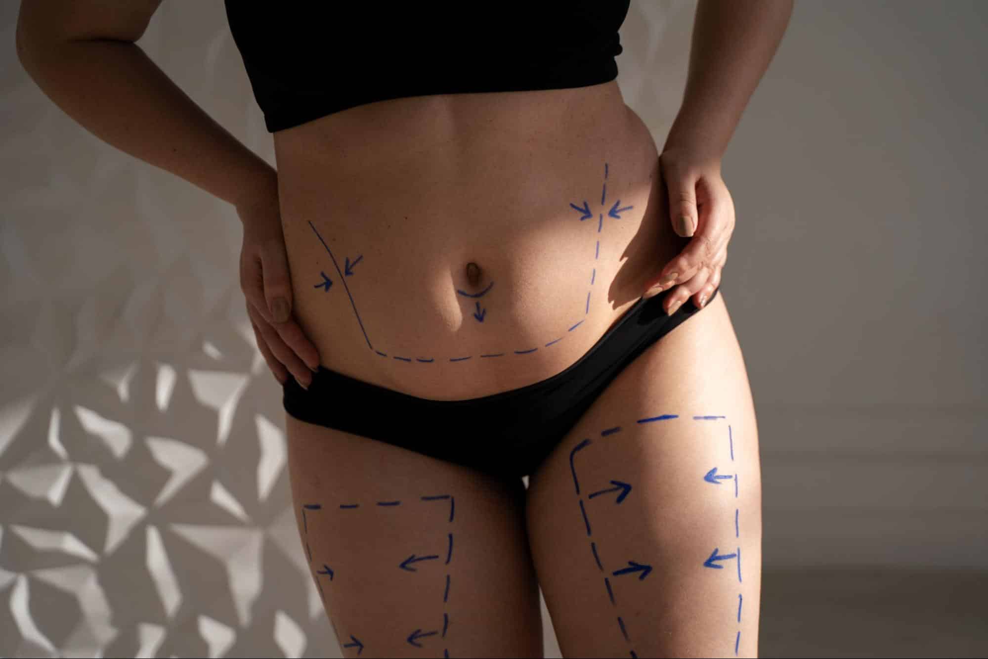 Precio para corregir o rellenar hip dips en Cirumed Clinic Marbella