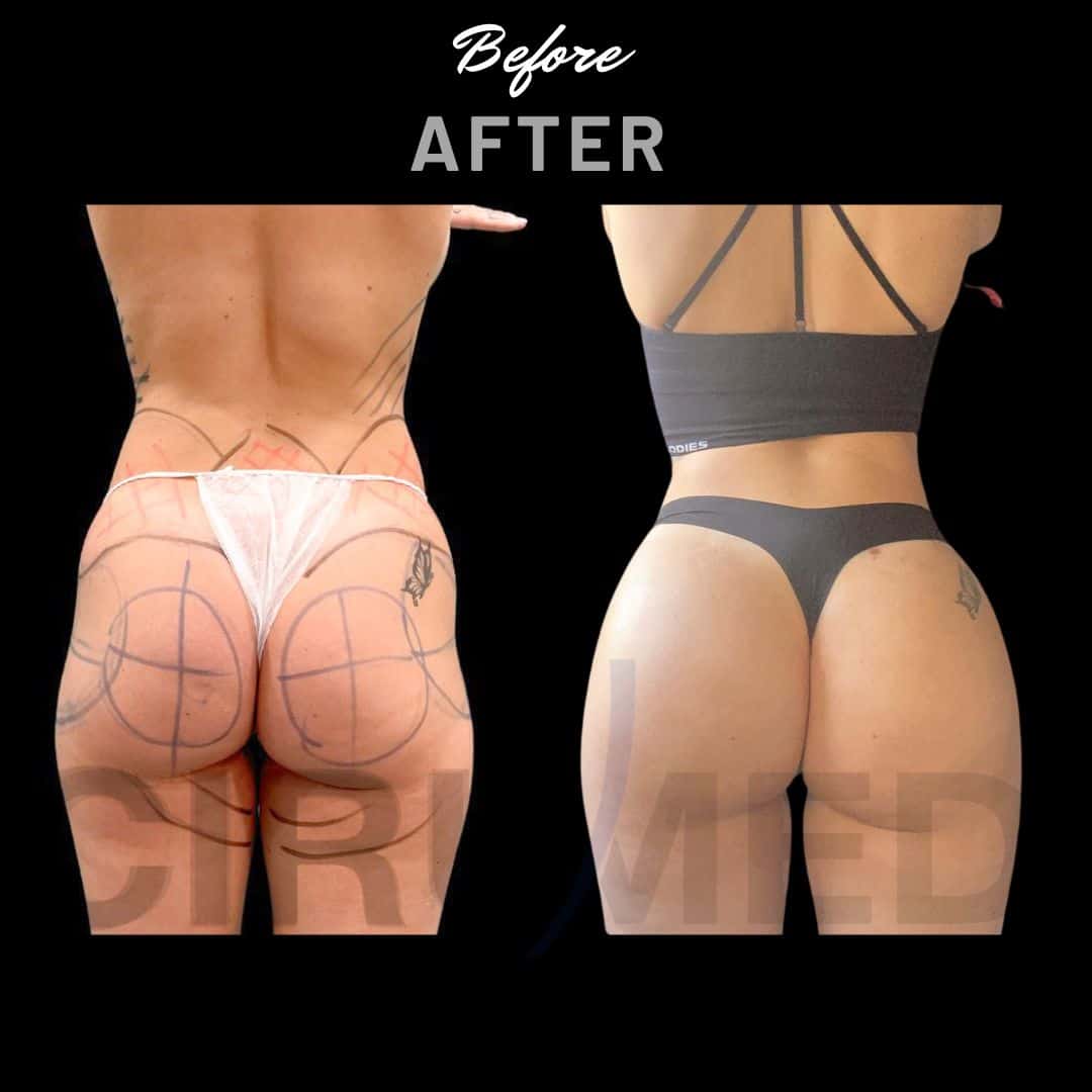"Buttock augmentation results in Marbella, Spain."
