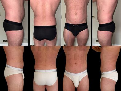 Male Liposuction Results - Before and After Transformation in Marbella, Spain