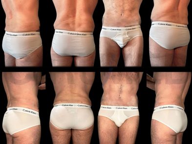 Results of abdominal liposuction performed in Marbella, Spain.