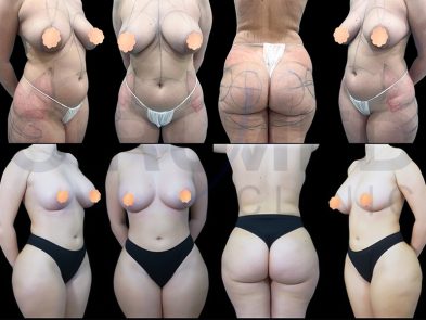 Breast augmentation and liposuction results in Marbella, Spain.