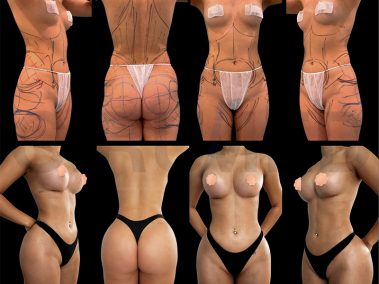"Antes y después de una cirugía de aumento de glúteos en Marbella - España."