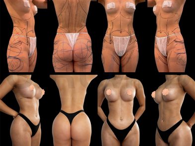 "Before and after buttock augmentation surgery in Marbella, Spain."