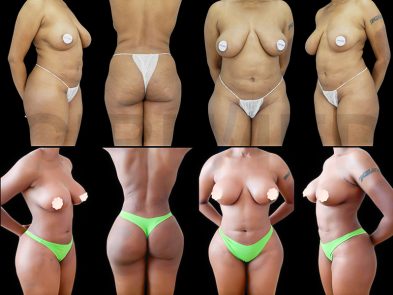Results of breast augmentation and liposuction in Marbella, Spain.