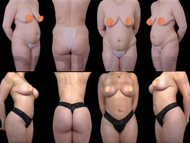 Results of breast augmentation and liposuction surgery in Marbella, Spain.