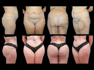 "Liposuction and buttock augmentation results in Marbella, Spain."
