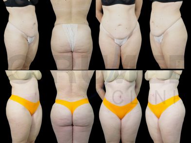 Result of liposuction of the abdomen and buttocks in Marbella, Spain.