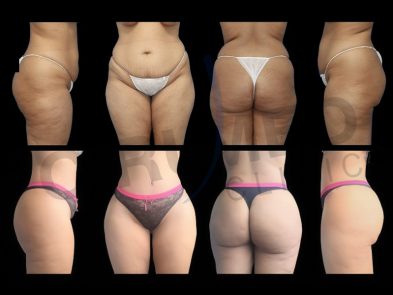 Before and after a buttock augmentation performed in Marbella, Spain.