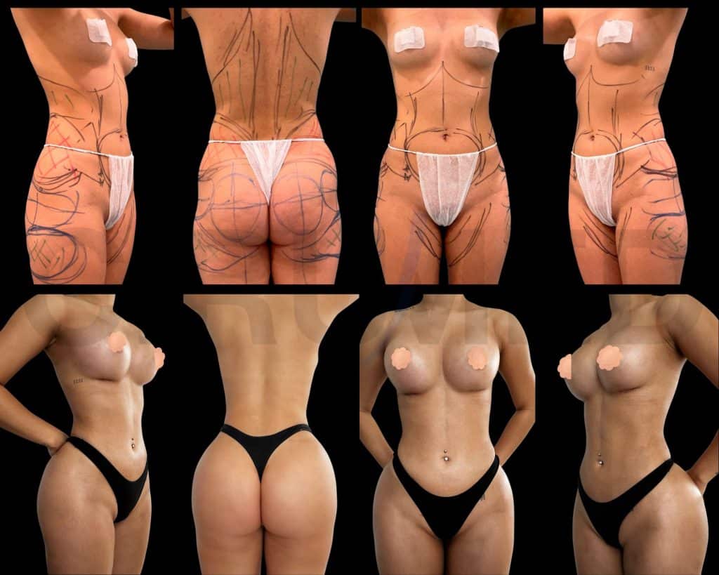 Lipotransferencia antes y después