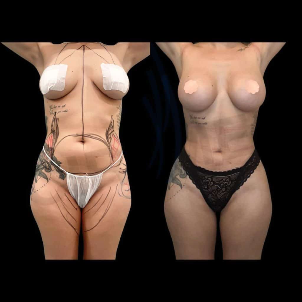 Lipoescultura — Cirumed Clinic Marbella