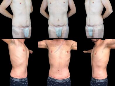 Result of abdominal liposuction in Marbella - Spain.