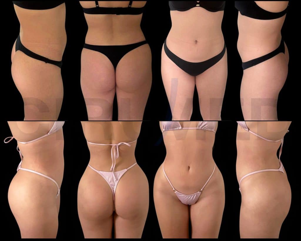 Lipotransferencia en glúteos