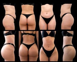 Resultados de un aumento de glúteos y liposucción antes y después en Cirumed Clinic, Marbella - España.