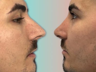 Before and after rhinoplasty performed in Marbella, Spain.