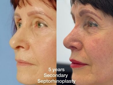 Result of a secondary rhinoplasty performed in Marbella, Spain, five years later.