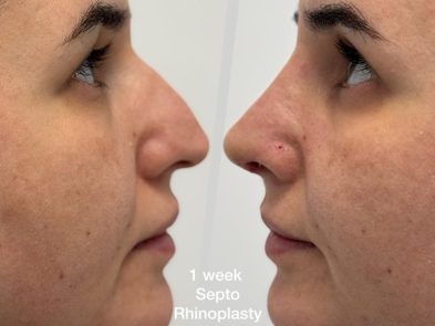 Results of a septal rhinoplasty one week after the procedure in Marbella, Spain.